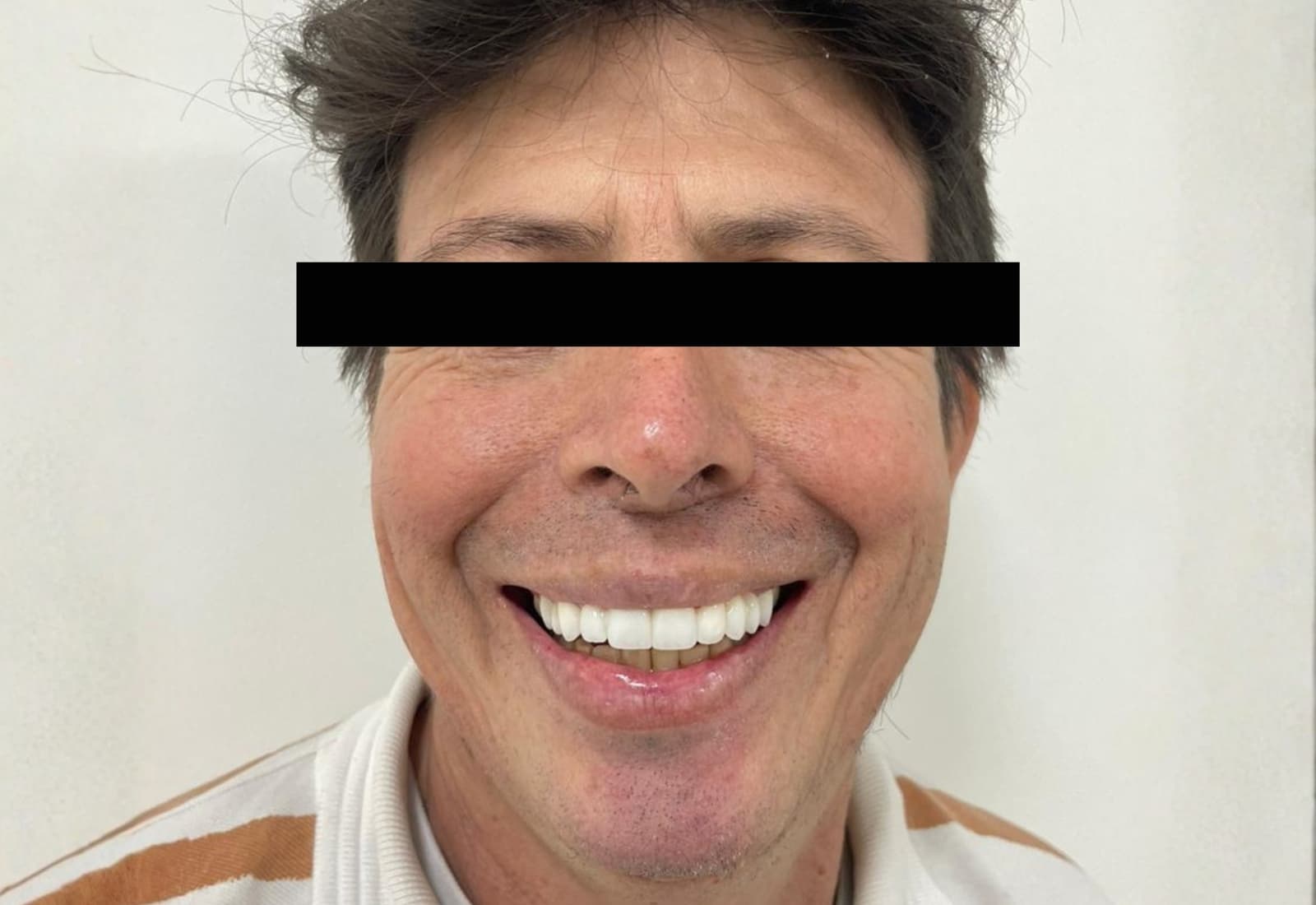 Smile after dental treatment